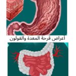 أعراض قرحة المعدة والقولون وأفضل طرق العلاج