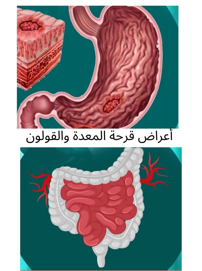 أعراض قرحة المعدة والقولون